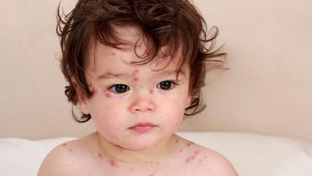 پنجاب،خسرہ بڑھ گیا،ایک روز میں279کیسز
