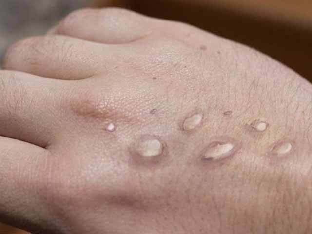 پاکستان میں منکی پاکس کا دوسرا کیس پشاور ایئرپورٹ پر رپورٹ